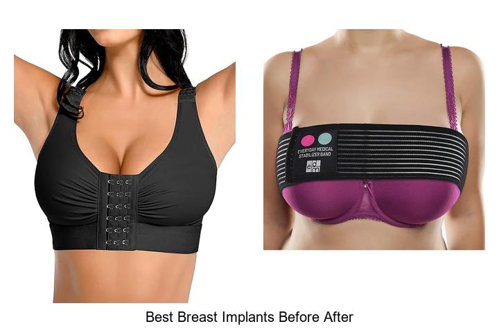 Best Breast Implants Before After Photos That Will Shock You